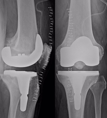 Radiografia post-operatoria di profilo