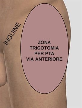 ricotomia per protesi totale di anca via anteriore