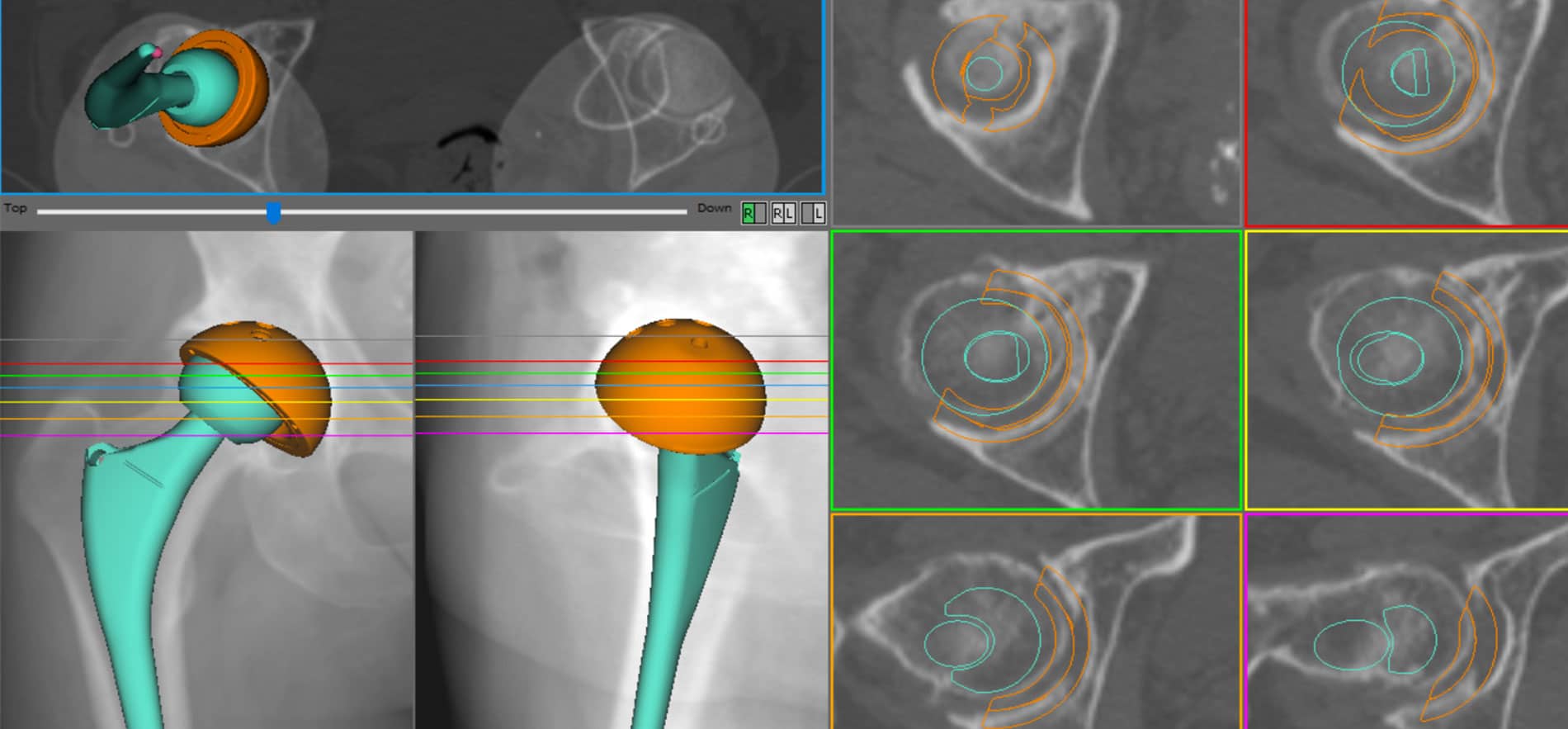 La pianificazione tridimensionale della protesi di anca